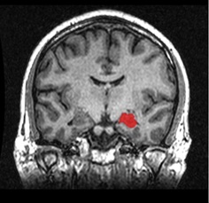 図２　MRI画像。海馬。