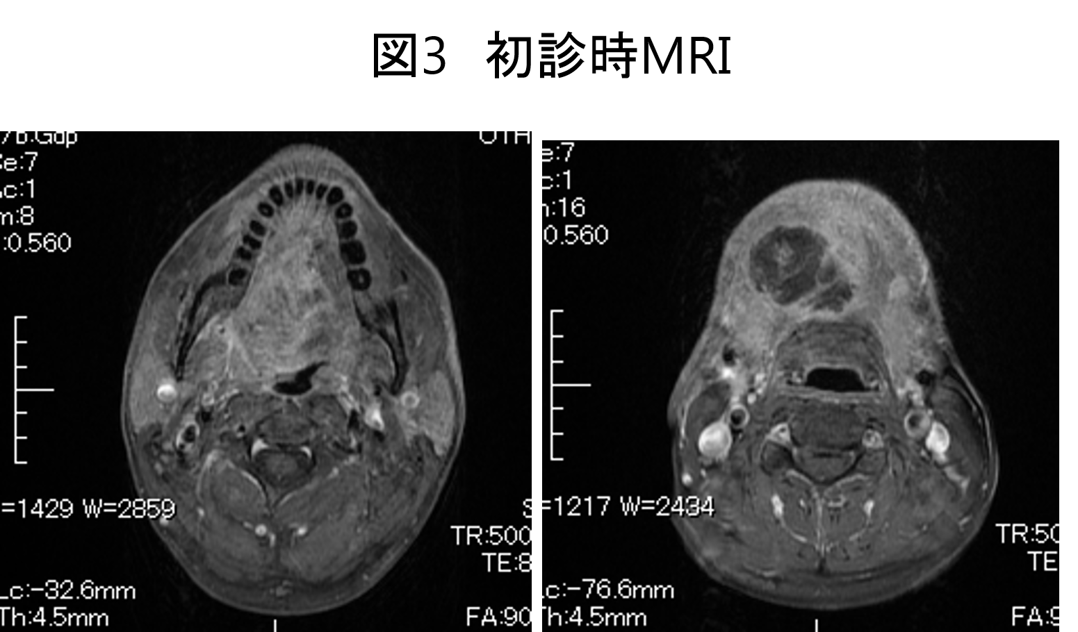 図3 初診時MRI