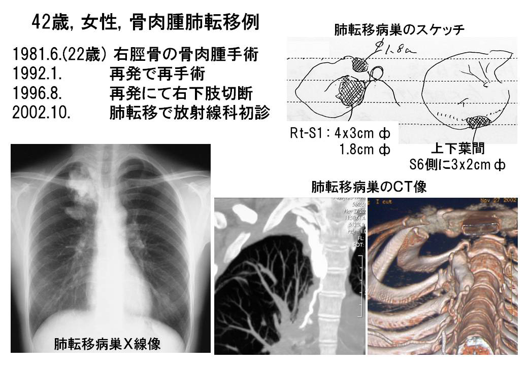 図1 肺転移病巣の状態