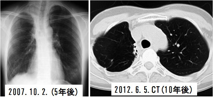 図4 治療後の胸部正面X線単純写真とCT画像